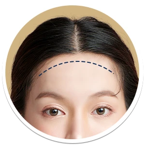 Forehead Feminization | Milada Plastic Surgery Hospital