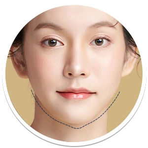 Chin to Jaw Reduction | Milada Plastic Surgery Hospital