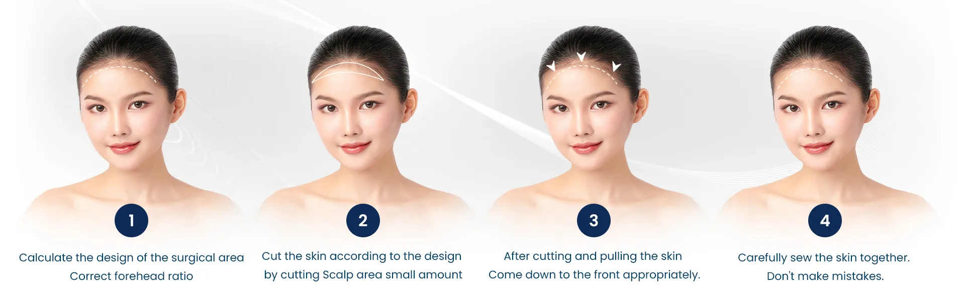 Milada Plastic Surgery Hospital | Forehead Reduction Procedure