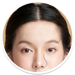 ผ่าตัดแก้ไขจมูก