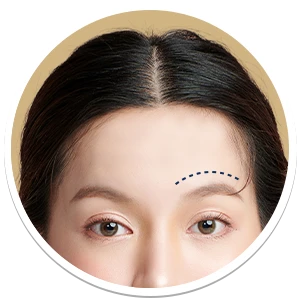 ผ่าตัดโหนกคิ้ว (Eyebrows feminization)