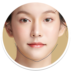 Chin to Jaw Reduction | Milada Plastic Surgery Hospital