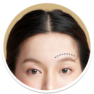 Eyebrows Feminization | Milada Plastic Surgery Hospital