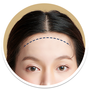 Forehead Feminization | Milada Plastic Surgery Hospital